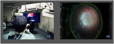 Enhancing surgical precision and efficiency: a study and comparison of a three-dimensional surgical video system in proliferative diabetic retinopathy surgery